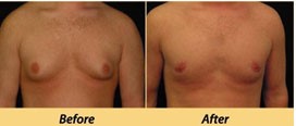 Male breast (gynaecomastia) reduction surgery
