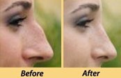 Nose job (Rhinoplasty)