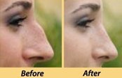 Nose job (Rhinoplasty)