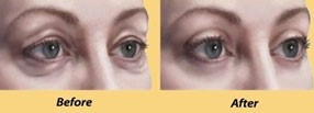 Eye lid surgery (Blepharoplasty)