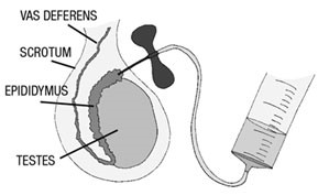 Percutaneous Epididymal Sperm Aspiration (PESA)
