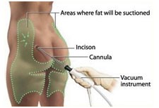 Liposuction (suction assisted lipectomy)