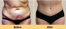 Tummy tuck (Abdominoplasty)