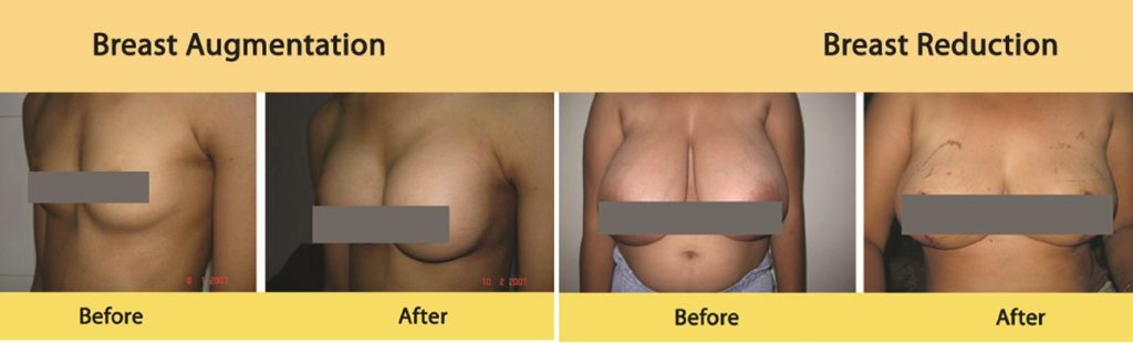 Breast Augmentation, Reduction or Reconstruction (Mammaplasty)
